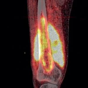 Osteomyelitis